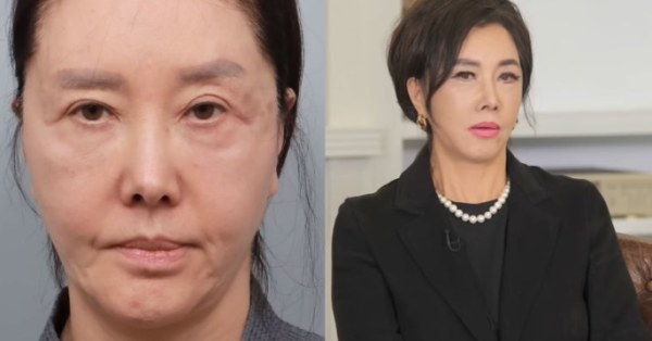 유혜리, 62세에 안면거상+지방재배치 공개