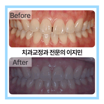 떨어진 유지 장치로 인한 앞니 벌어짐 인비절라인을 이용하여 재교정한 사례
