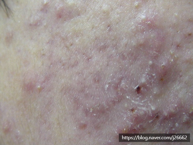 Shamban과 Narurka에 의한 여드름 척도 (The Shamban Acne Scale) : 네이버 블로그