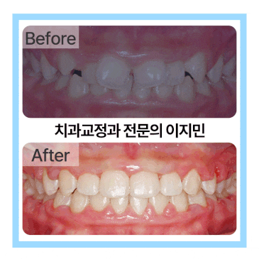 청소년기 심하게 삐뚤어진 치아 개선 어느 시기에 받아야 좋을까?