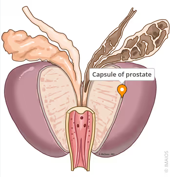 전립선이 아픈 이유, 정말 전립선 자체 때문일까? : 전립선 피막(Prostate Capsule)의 중요성 : 네이버 블로그