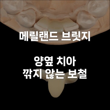 메릴랜드 브릿지 양옆 치아 안 깎는 보철