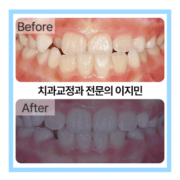 아이의 얼굴을 바꾸는 가장 자연스러운 방법, 소아 주걱턱 조기 교정