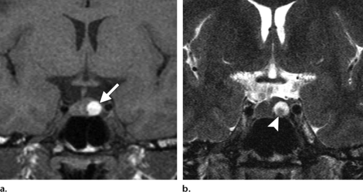 라트케열 낭종 (Rathke's Cleft Cyst) : 네이버 블로그