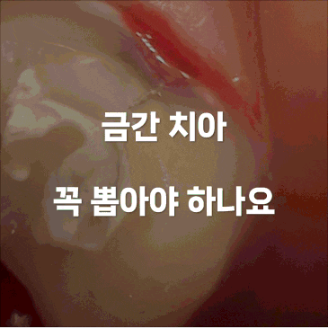금 간 치아 꼭 뽑아야 하나요