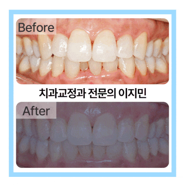 교정 후 다시 틀어진 앞니 부분교정으로 재교정이 가능할까? 가능한 기준을 알려드립니다.