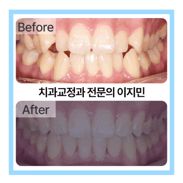 주걱턱 비대칭 교정, MARPE 성인 악궁 확장을 통한 비수술 교정