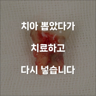 치아재식술 뽑은 어금니 다시 심어 살립니다
