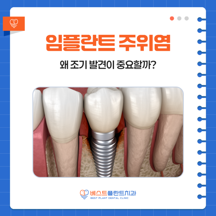 창원상남치과 임플란트 주위염 초기 단계, 왜 조기 발견이 중요할까