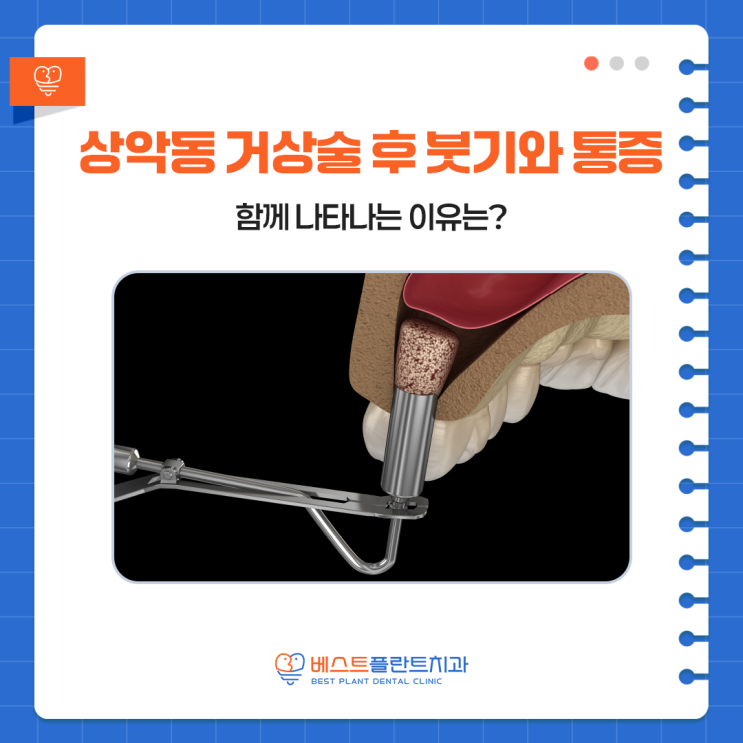 성산구상남동치과 상악동 거상술 후 붓기와 통증, 함께 나타나는 이유는?