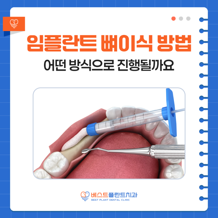 창원반송동치과 임플란트 뼈이식 방법, 어떤 방식으로 진행될까요