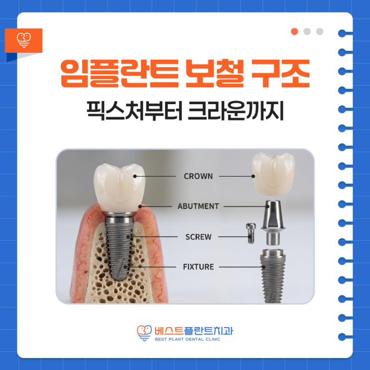 사파동치과 임플란트 보철 구조 이해하기 (픽스처부터 크라운까지)
