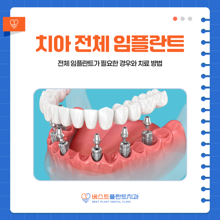 창원성산치과 치아 전체 임플란트가 필요한 경우와 치료 방법