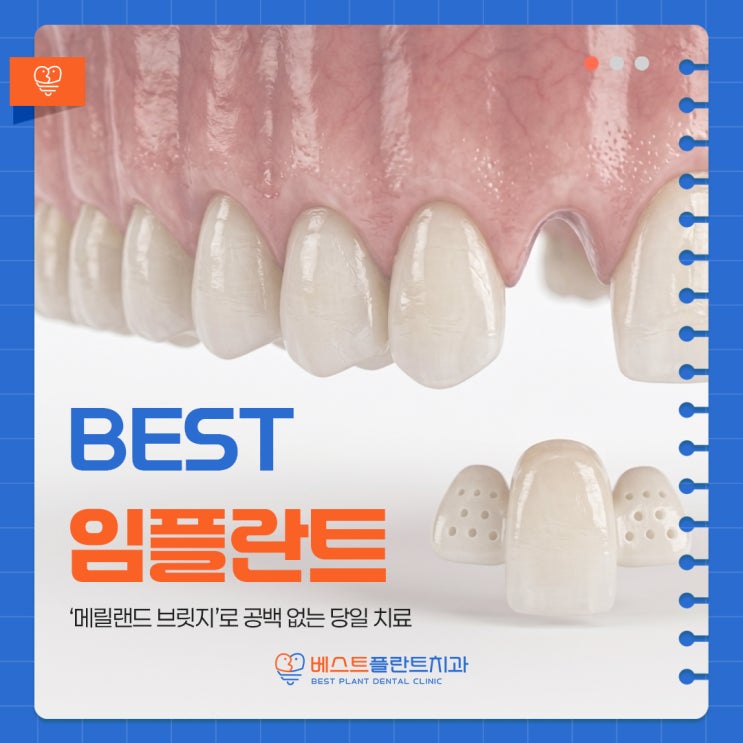 창원상남치과 앞니 임플란트, 메릴랜드 브릿지로 공백 없는 당일 치료 가능할까?