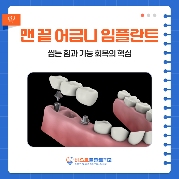 창원임플란트치과 맨 끝 어금니 임플란트, 씹는 힘과 기능 회복의 핵심