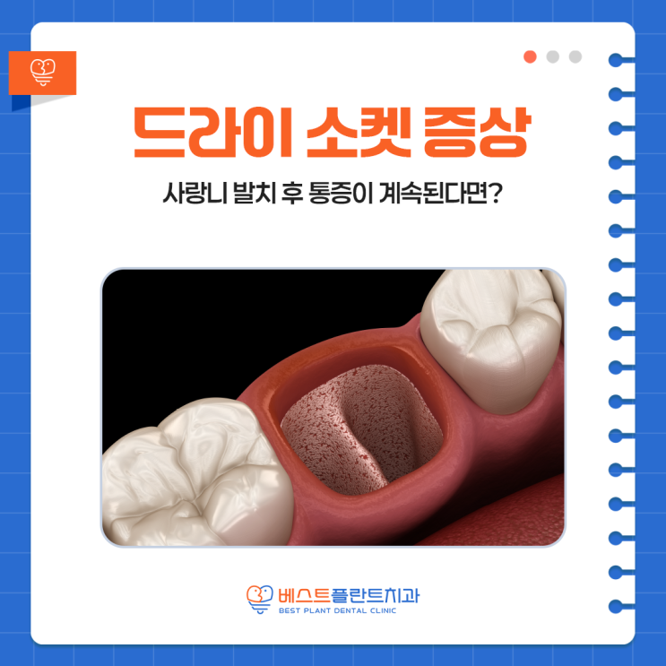 창원중앙동치과 사랑니 발치 후 통증이 계속된다면? 드라이 소켓 증상 확인하세요