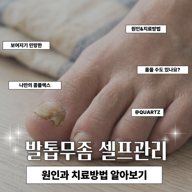 발톱무좀 원인과 치료방법, 셀프 관리만으로는 어려웠던 이유