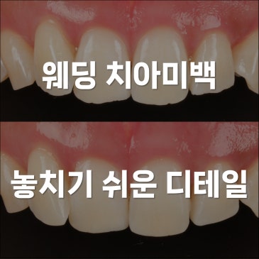 웨딩 치아미백 전 놓치기 쉬운 디테일