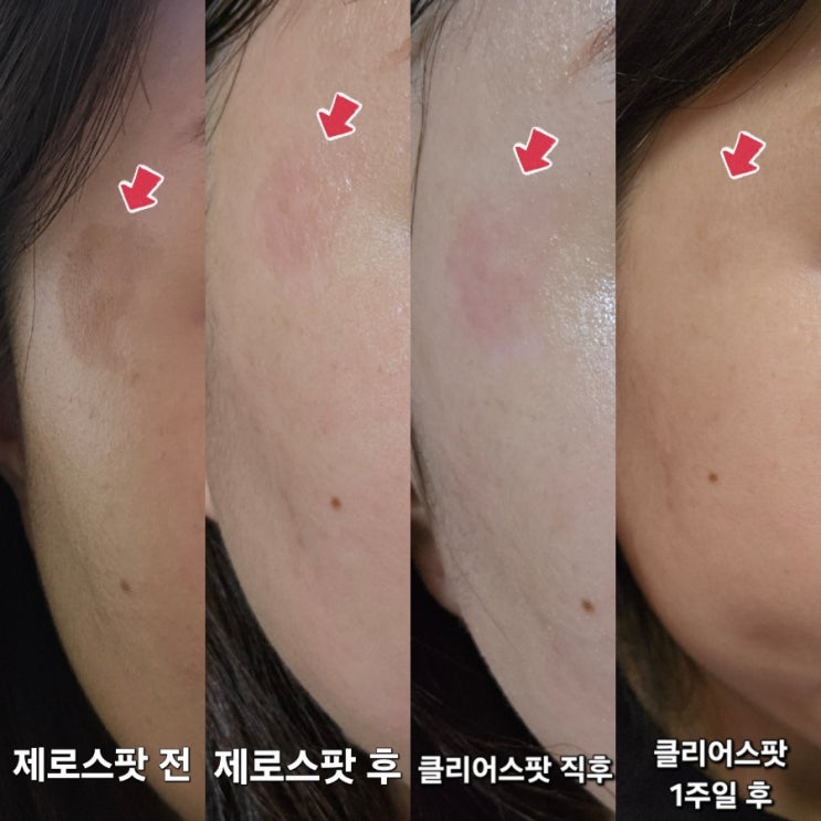 별내 신내 기미잡티제거 클리어스팟 프로 미작뷰티 중계점 : 네이버 블로그
