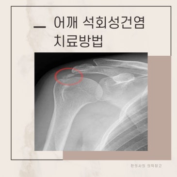 어깨 석회성건염 원인 증상 치료