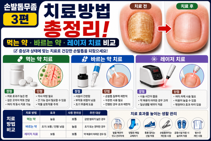 3. 손발톱무좀 치료방법 총정리, 먹는약/ 바르는 약/ 레이저 치료 비교