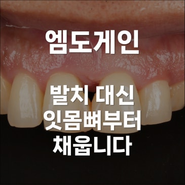엠도게인, 발치 대신 앞니 살리기 잇몸뼈부터 채웁니다