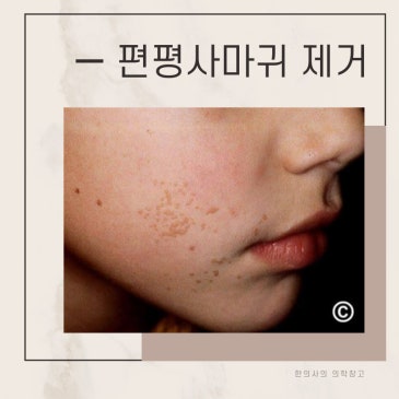 일산 편사 성지 편사무제한제거, 편평사마귀 치료