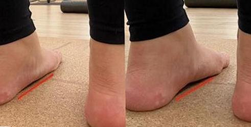 족저근막염 치료방법 네 가지 겪고 8개월 만에 아침 통증 사라진 기록