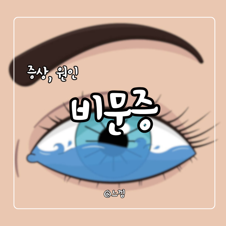 비문증 증상 원인 비문증 치료방법 검사