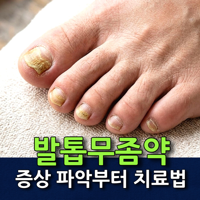 발톱무좀 증상 파악부터 초기 발톱무좀약 치료 방법