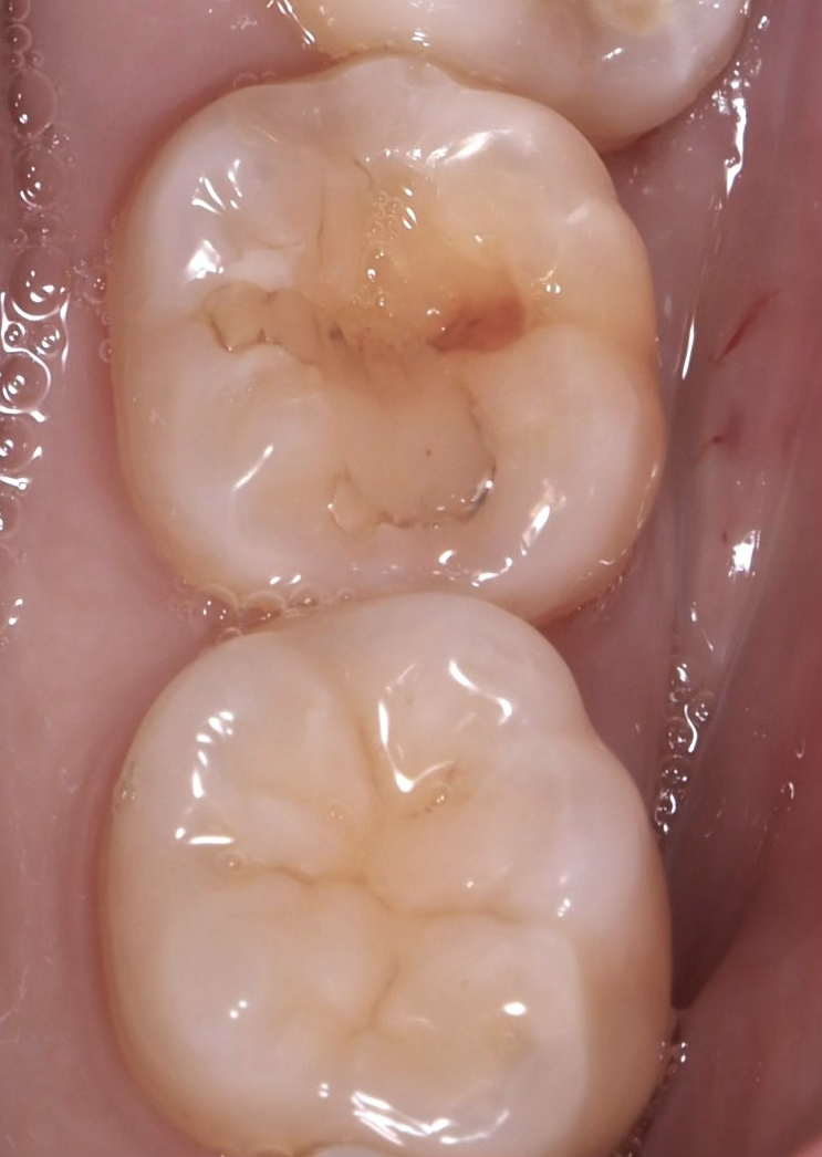 사당역치과 깨진 어금니 충치, 직장인 당일 레진 빌드업 증례 (큐레이펜 진단 과정)