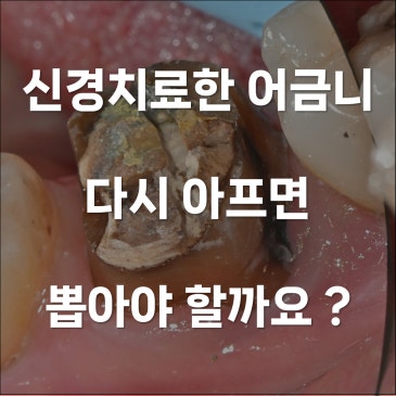 신경치료한 어금니 다시 아프면 뽑아야 할까