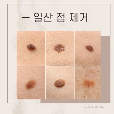 일산점제거 성지