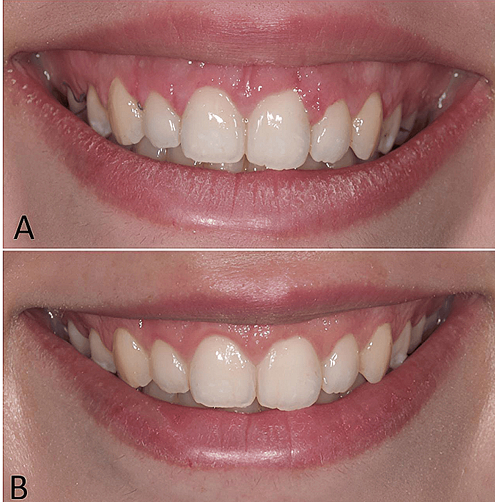 Gongdeok Station Dental Clinic: Why Gum Line is More Important Than Tooth Shape for Laminates