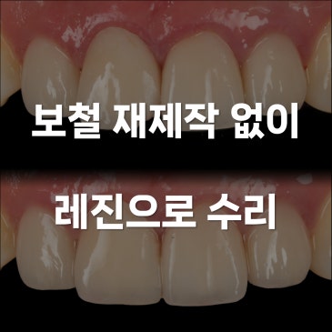 앞니 보철물 파절 재제작 없이 레진으로 수리