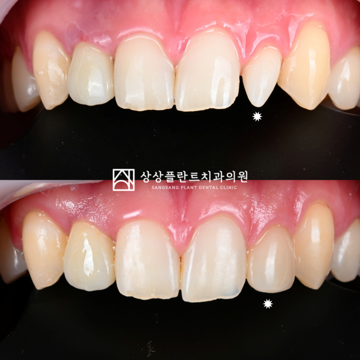 크기가 작은 앞니 왜소치, 치아 삭제 없이 당일 레진으로 자연스럽게 다시 만든 케이스 : 네이버 블로그