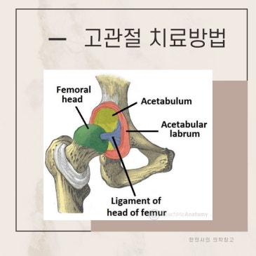 걸을 때 사타구니가 아프다면? 고관절 통증, 왼쪽 오른쪽 위치에 따라 치료가 달라집니다
