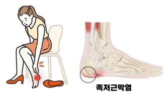 아침에 첫발 디딜 때 통증? 족저근막염 증상과 원인, 치료방법 총정리 발바닥 통증