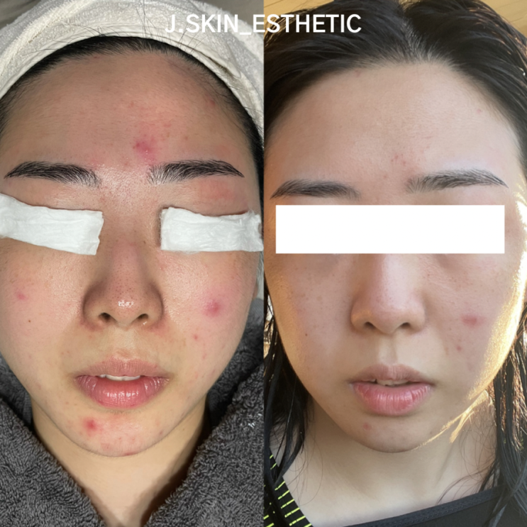 medical skin-care program line up ; 진피린 : 네이버 블로그