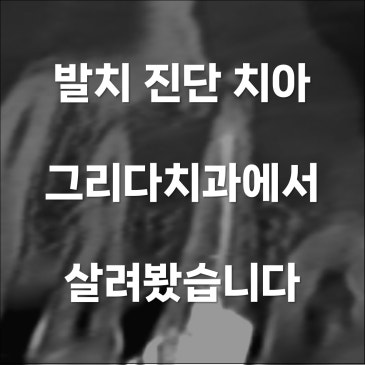 치근단절제술 임신 중에도 지킨 어금니