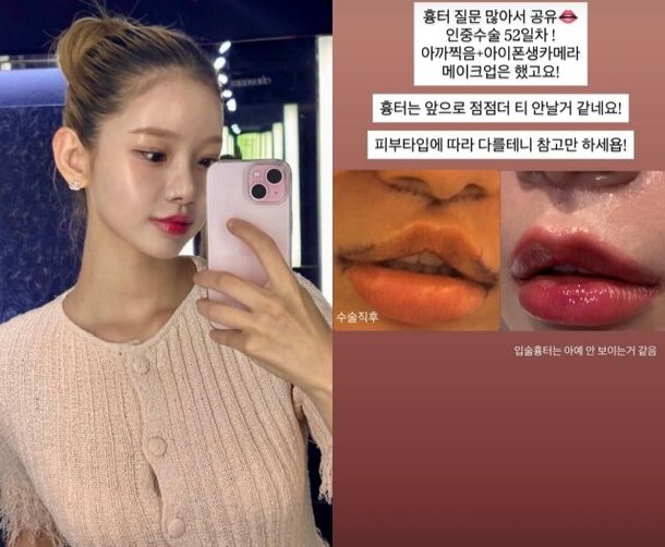 배우 맹승지, 인중 수술 52일 차 근황 공개 "흉터 거의 사라져"