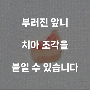 부러진 앞니 붙이기 원래 조각 그대로 재부착
