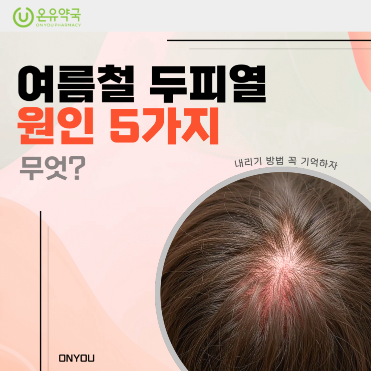 여름철 두피열 원인 5가지, 내리기 방법 꼭 기억하자