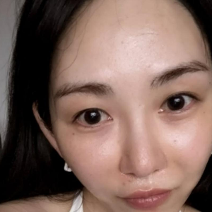 "성형 안 했습니데이" 화상 사고 겪은 권민아가 직접 밝힌 얼굴 변화