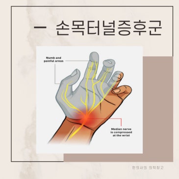 수근관증후군 손목터널증후군 수술 없는 치료 방법