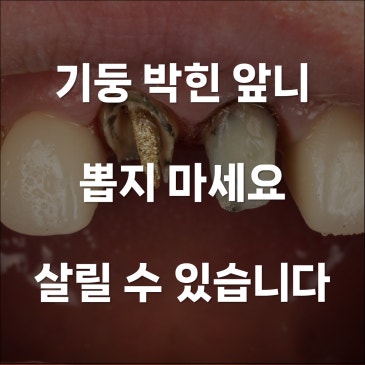 재신경치료로 기둥 박은 앞니 지킨 과정