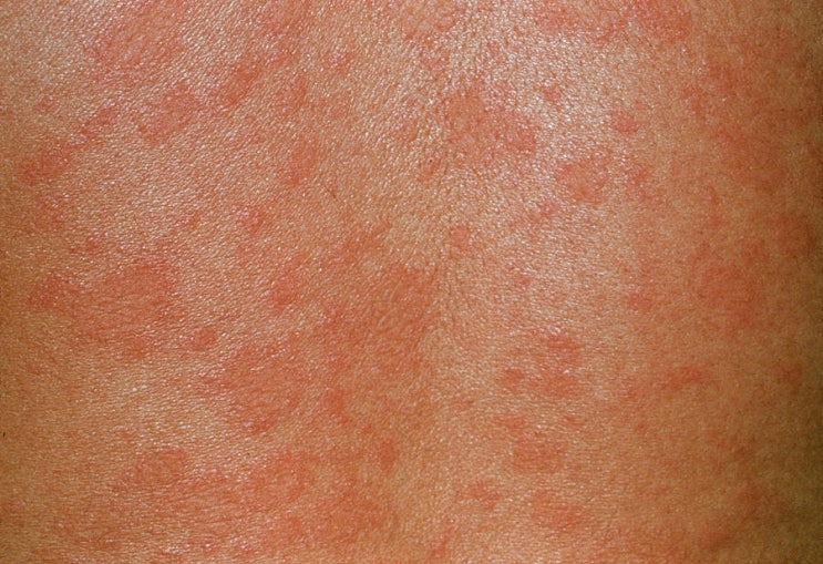 몇 달이 지나도 심각했던 장미색 비강진, 한방치료 받아본 후 : 네이버 블로그