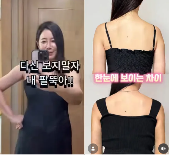 '서프라이즈' 김하영, 팔뚝 지방흡입 비포·애프터 공개 "1700cc 제거, ....