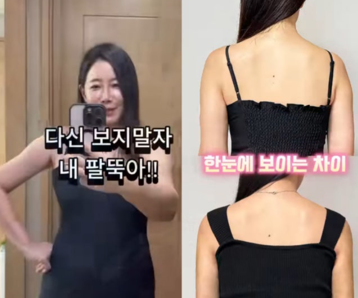 “12kg 뺐는데 팔뚝만 그대로”…김하영 결국 지방흡입, 비포·애프....