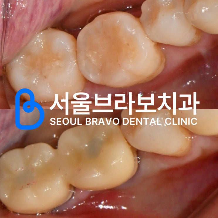 뼈이식 임플란트 수술 후 식사 메뉴, 음주, 양치 가능 여부 주의점 : 네이버 블로그